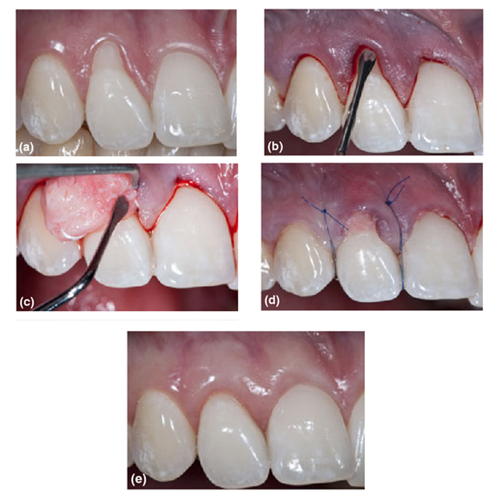 GDC Tunneling Knife 1 - 6 (TKN1)