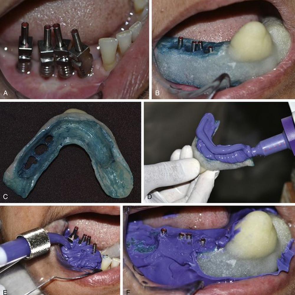Adin TMA Open Tray Impression Coping (RS5006)