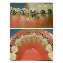 OSL TMA Straight Length Wires - Round (Pack Of 10) - 4