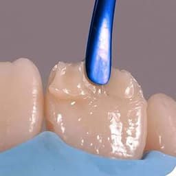 GDC Titanium Coated Composite Anterior Placing (Tncipcm) - 4