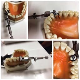 Waldent Tofflemire Retainer 8/105 - 7