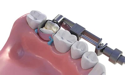 Samit Toffalmaire Retainer