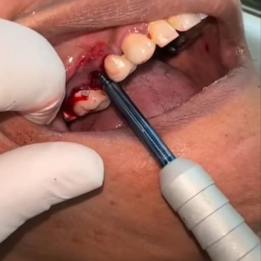Julldent 169 Pterygoid Path Finder ILM Tool