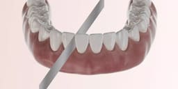 Tor Vm Metal Diamond Strips - 7