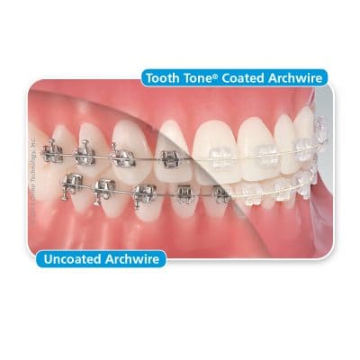 U ortho Niti Tooth Color Wire-Rectangular (Pack of 1)