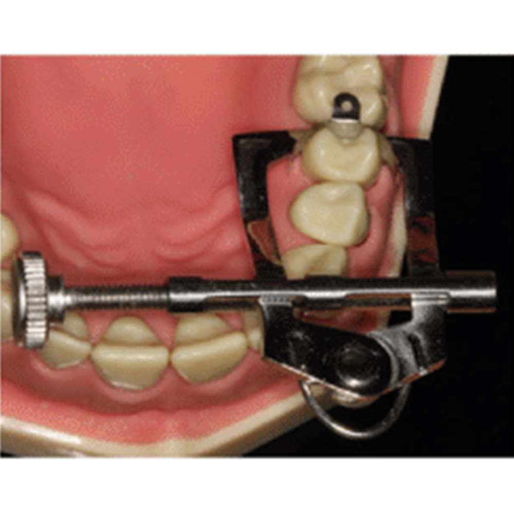 GDC Tooth Separator - (TSI)