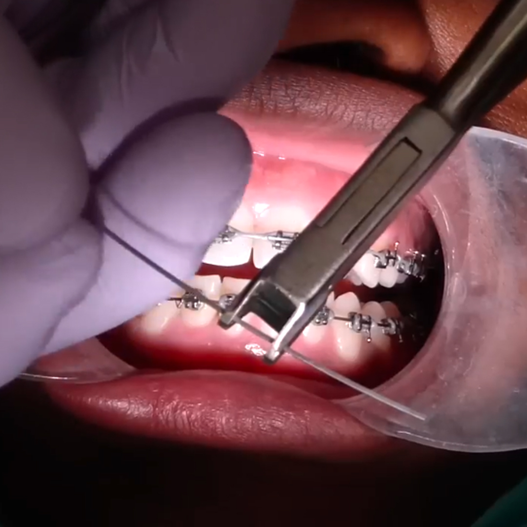 OSL Torquing Plier With Key