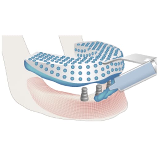Xcem Conical Impression Coping Transfer - Non Hex