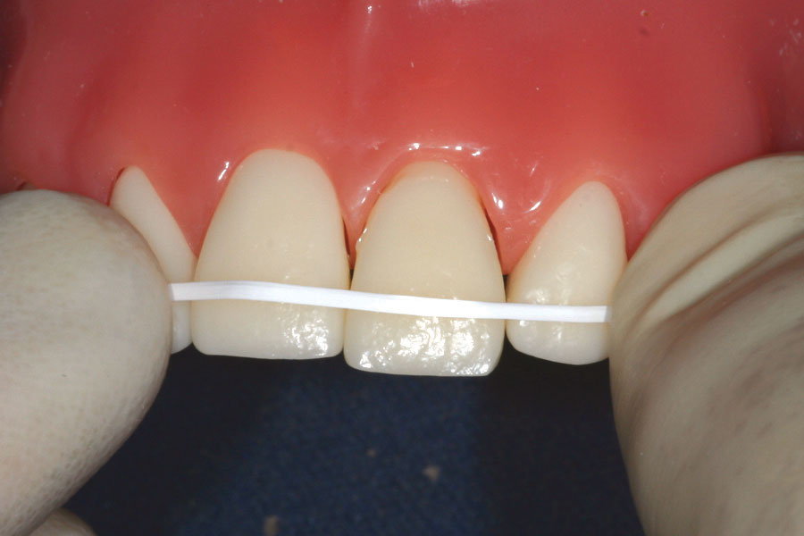 Ribbond Ribbon Fiber Splint Kit