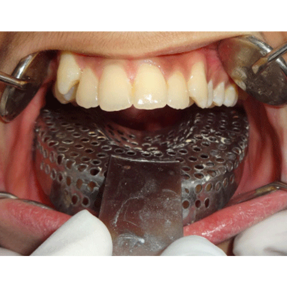 GI Dental Impression Tray (Dentulous) (Set of 10)