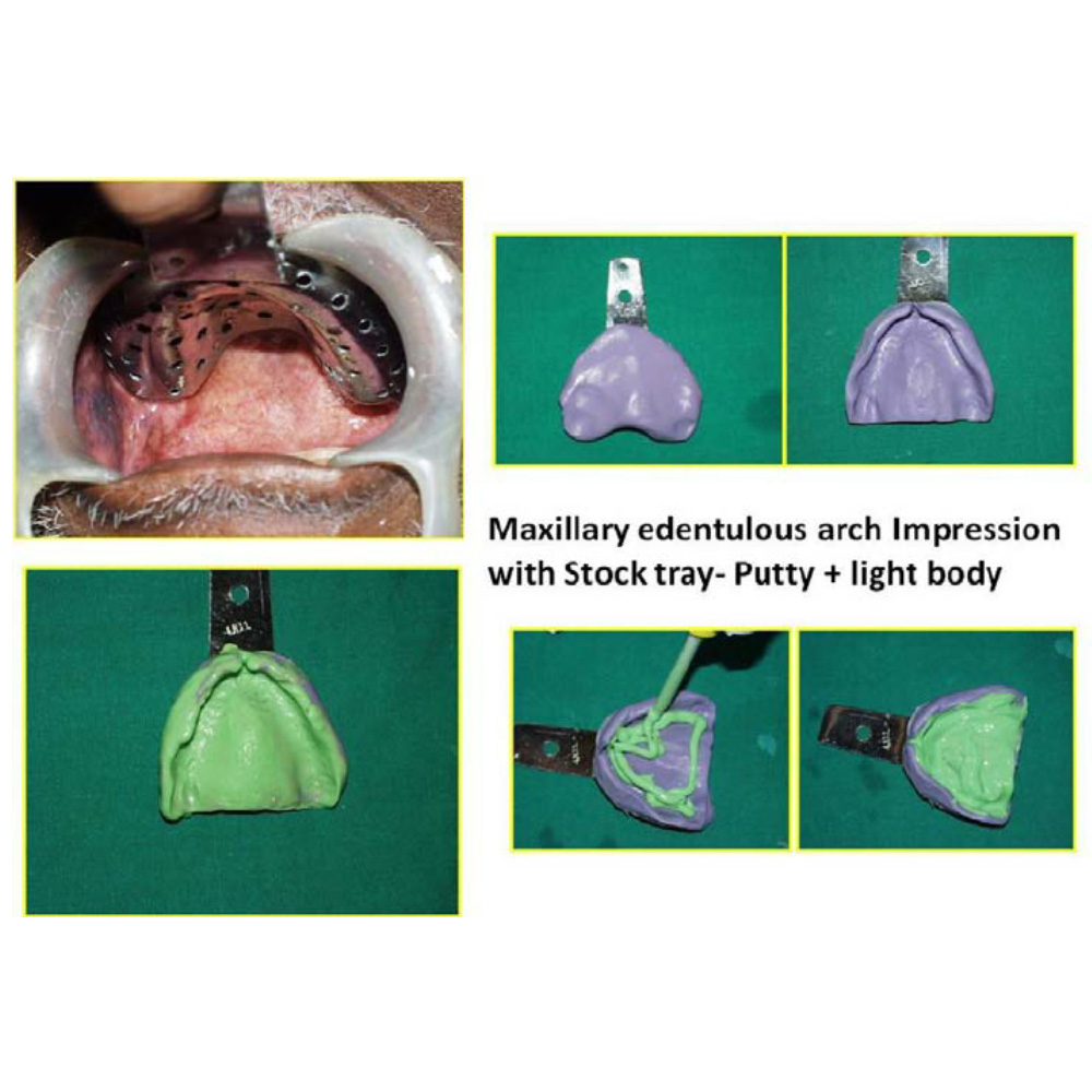 GDC Impression Trays Edentulous Perforated S/8 Instruments Kit (ITRLEDPP8)