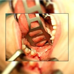 Oracraft Bruenings Retractor (TRB) - 5