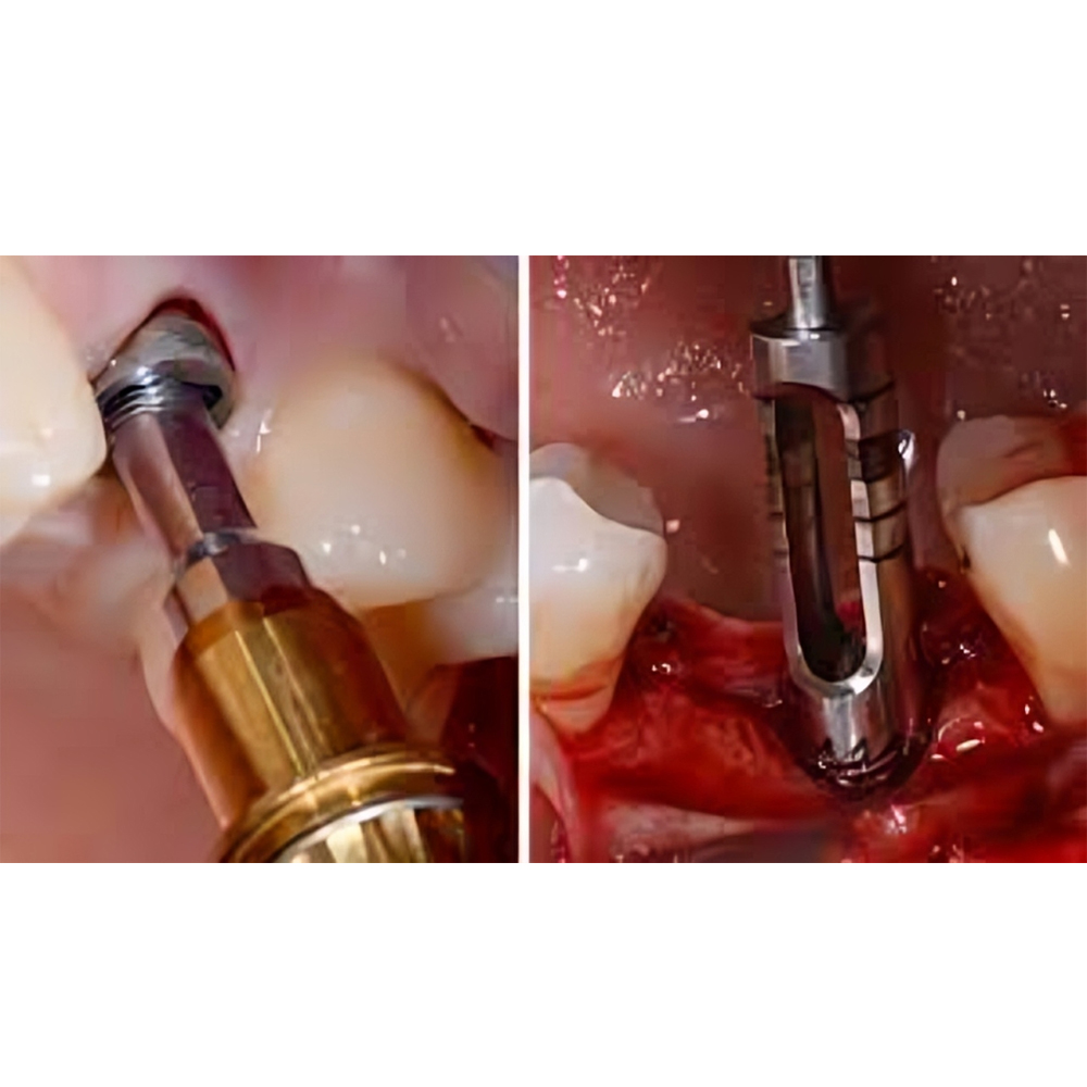 MCTBIO Trephine Burs