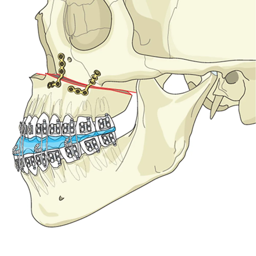 SK Surgicals Titanium Mini Bone Plates L Shape 90° With Gap - 2mm