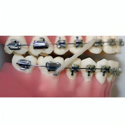 U Ortho Bondable Buccal Tubes - 1st Molar MBT 0.022 - 11