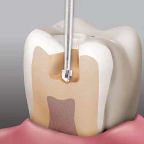 NewDiamond Round Carbide Straight Handpiece Bur-07 (Pack of 5)