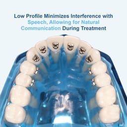 U Ortho Lingual Brackets 018 - 8