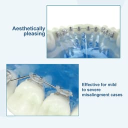 U Ortho Lingual Brackets 018 - 11