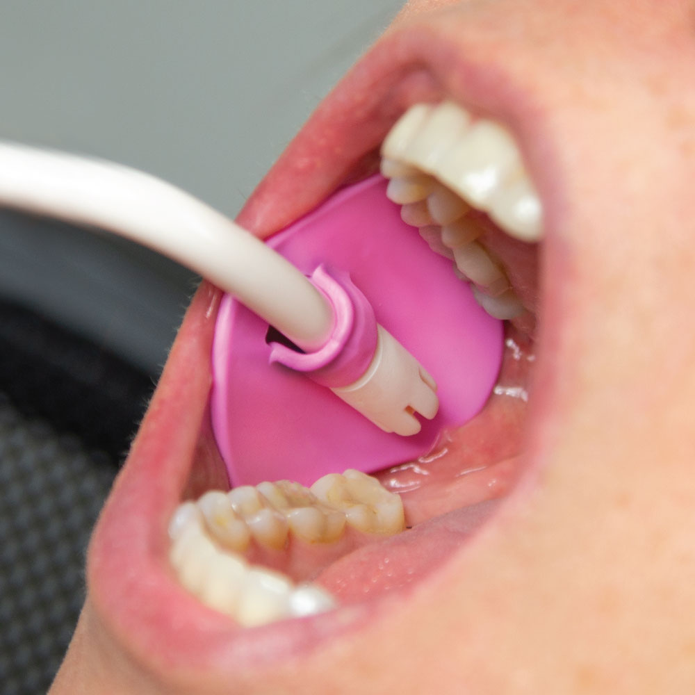 Zirc Pink Petal Saliva Ejector Attachment (Pack of 3)