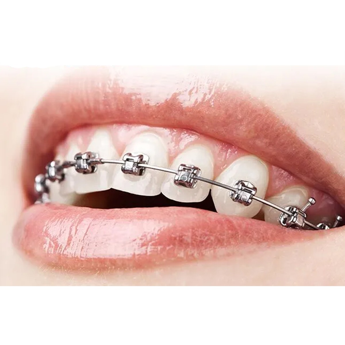 OrthoMetric Ultra-P Self Ligating Bracket Kit + Arch Sequence