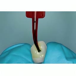 Ultradent Porcelain Etch Refill # 406-1 - 4