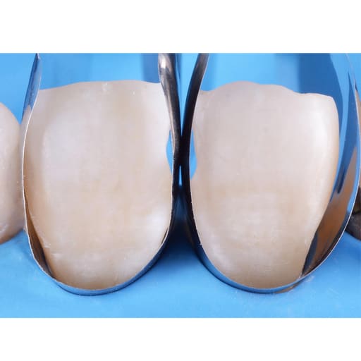 Polydentia Unica Anterior Matrix System Kit & Refills