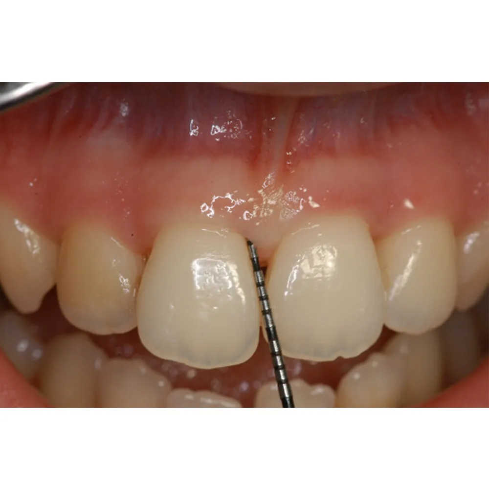 Waldent UNC 15 Probes