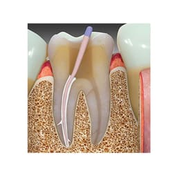 Prime Dental Prime MTA Bioceramic Root Canal Sealer - 3