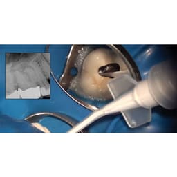 Prime Dental Prime MTA Bioceramic Root Canal Sealer - 4