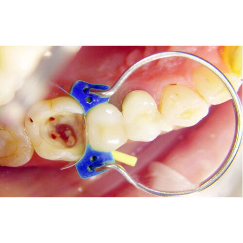 Tor Vm Add-On Fixing Wedges 40 Pcs (1.866)