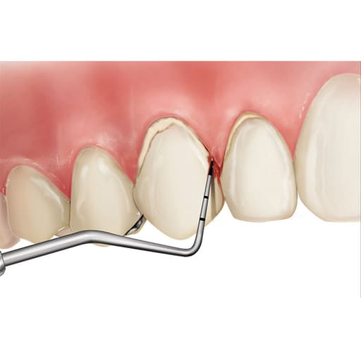 Oracraft Periodontal Probes
