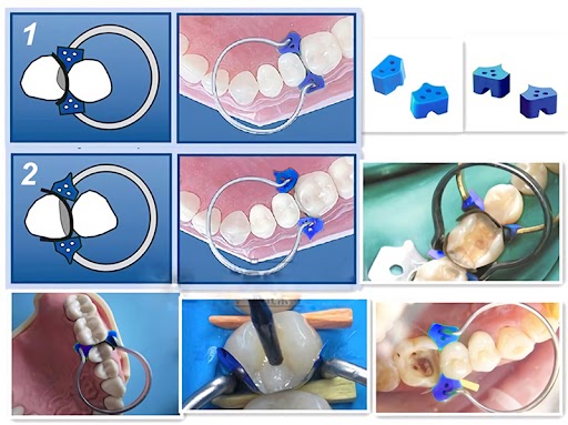 Tor Vm Add-On Fixing Wedges 40 Pcs (1.866)