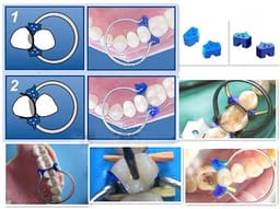 Tor Vm Add-On Fixing Wedges 40 Pcs (1.866) - 5