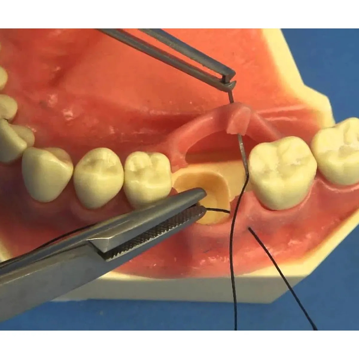 Meril Filapron #3-0 Polyglecaprone 25 Suture