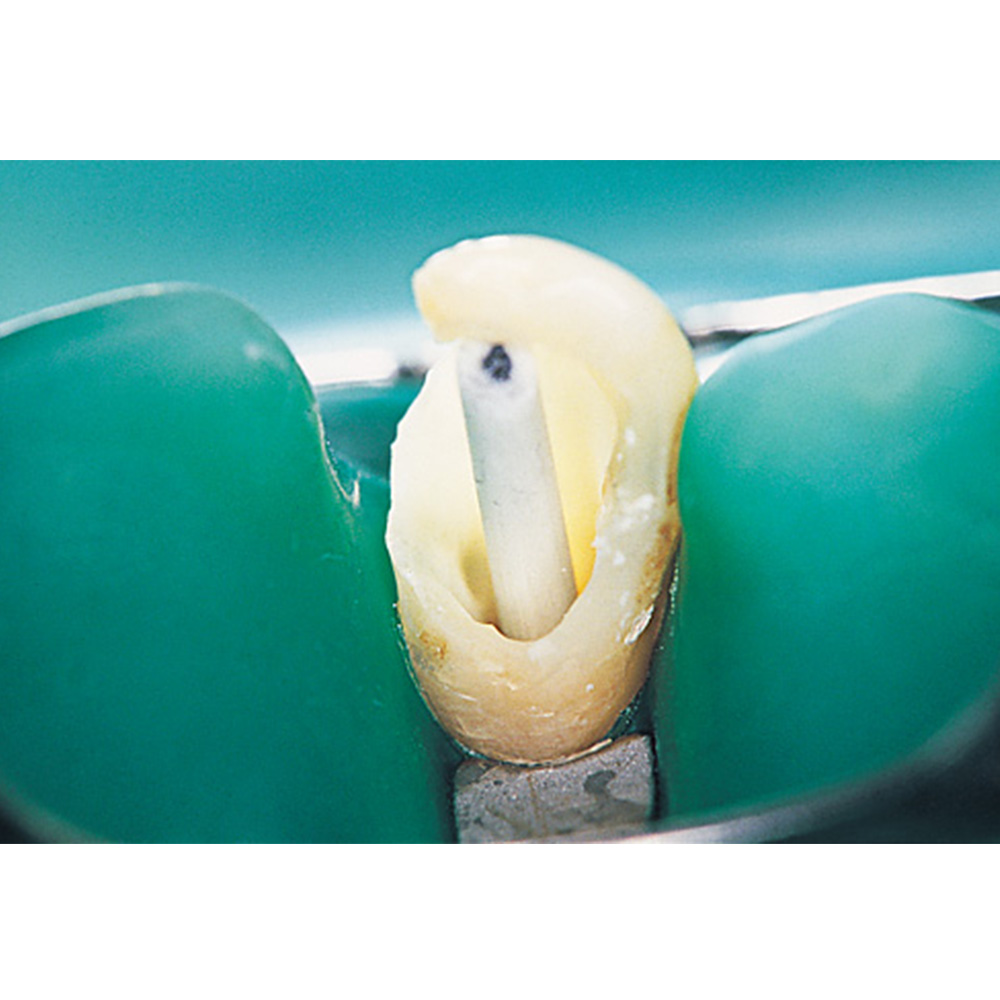 AAA Fiber Post Pack of 10