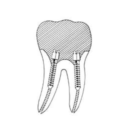 EndoKing Dental Conical Screw Posts  - 14