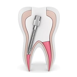 EndoKing Dental Conical Screw Posts  - 13
