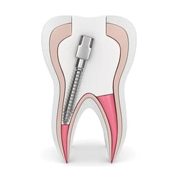 EndoKing Dental Conical Screw Posts (Pack of 240) - 6
