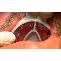 Cotisen Implant Impression Tray Insert Refills - 6