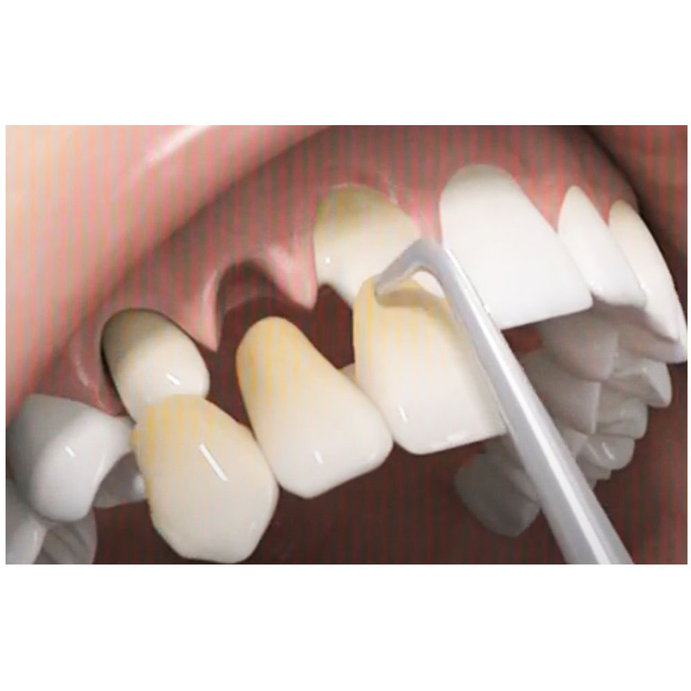 Waldent Crown Remover Tips