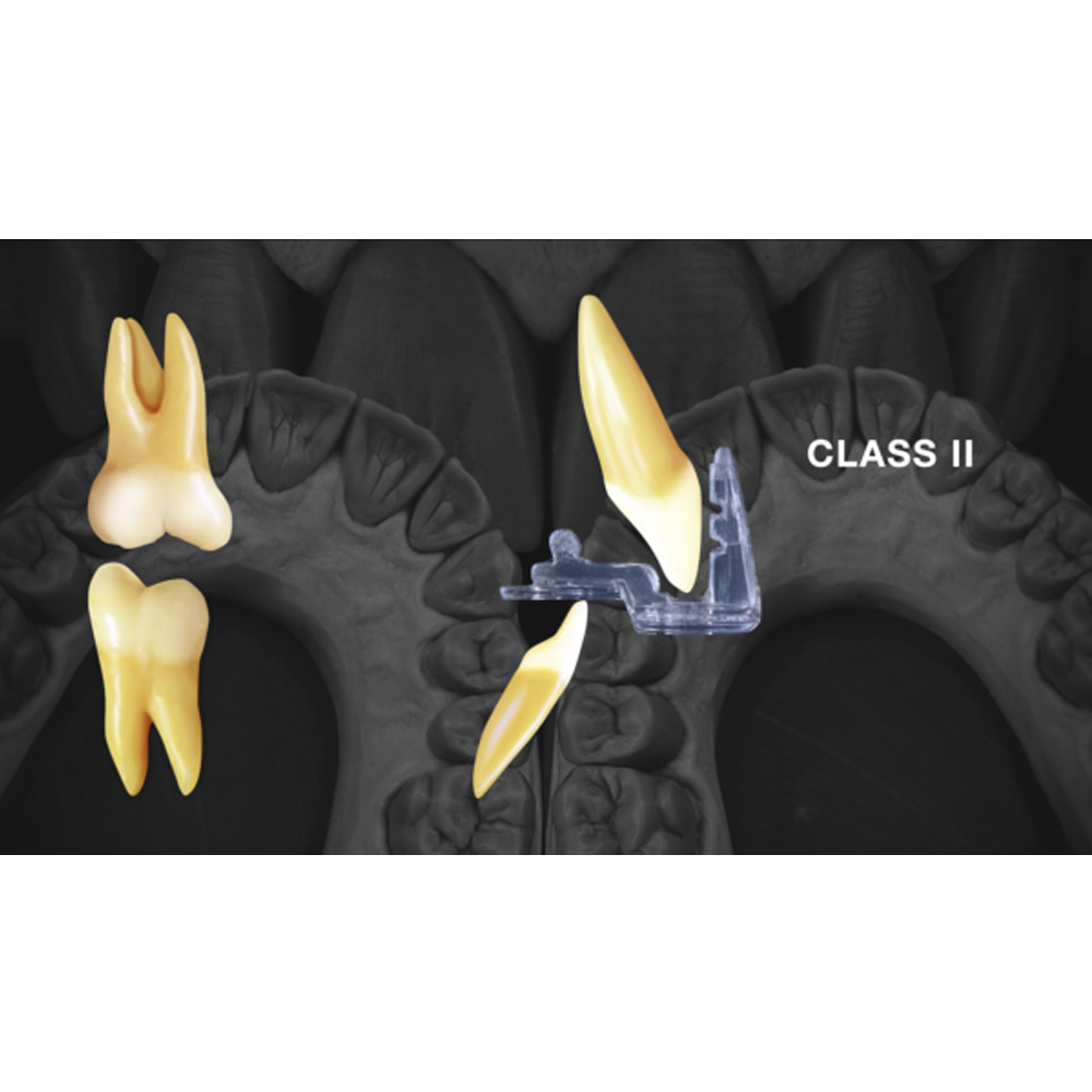 MiK Unwind MD Muscle Deprogrammer - Class II (Deep Bite)