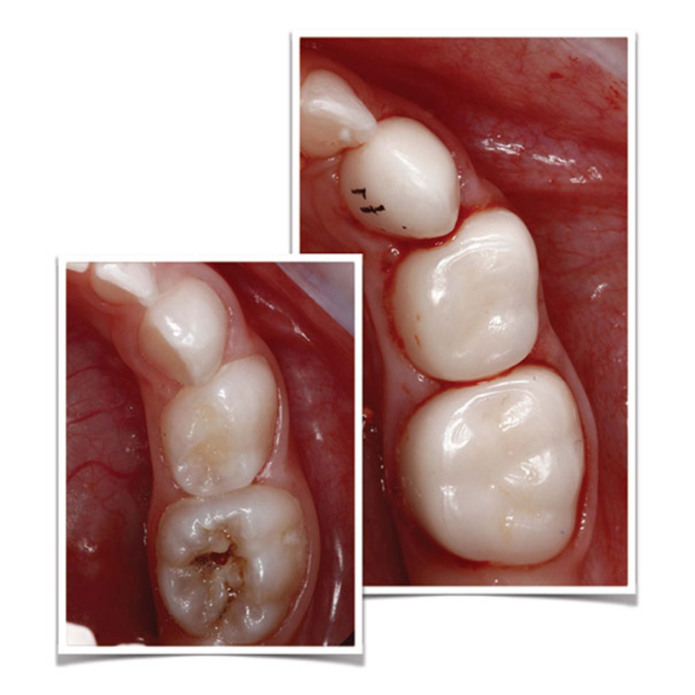 Kids-e-Crown Zirconia Upper Left 2nd Molar Refills