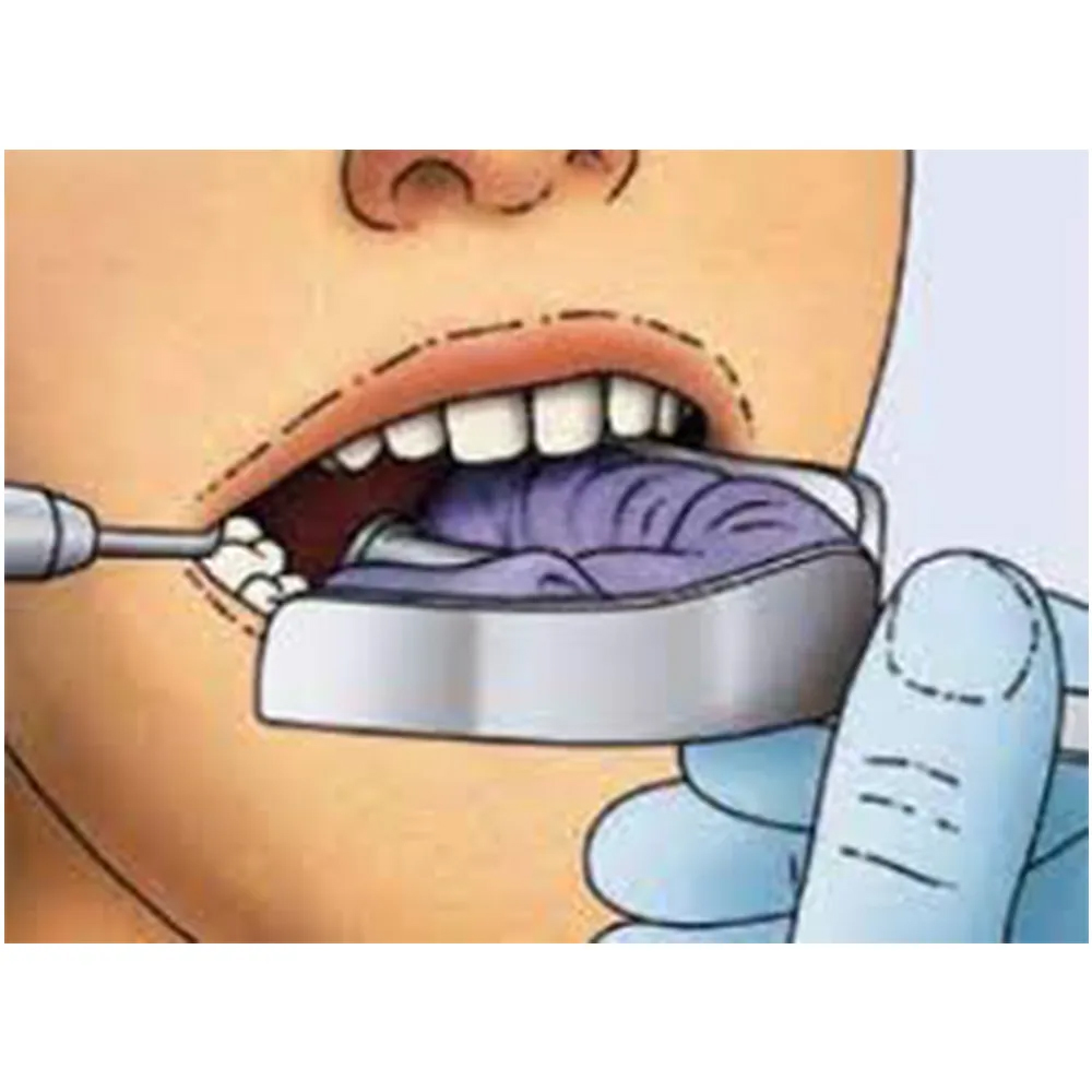 GDC Dentulous Non-Perforated Impression Trays Upper # 4 (ITRLDNPU4)