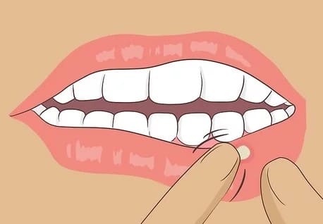 Ortis Star Smile Mouth Ulcer Gel