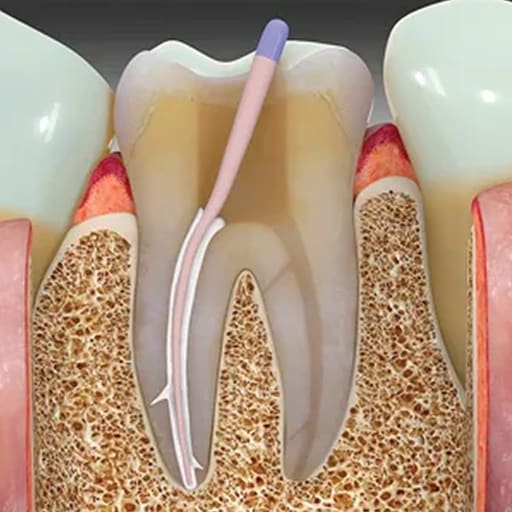 Vishal Dentocare Quick Seal Root Canal Sealer With Dexamethasone