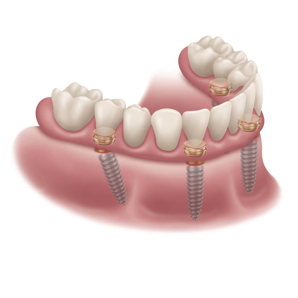 Xcem Denture Locator Abutment Mini - Hex