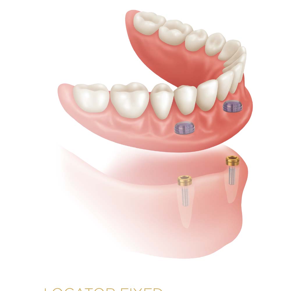 Xcem Denture Locator Abutment - Hex