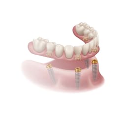 Xcem Denture Locator Abutment Mini - Hex - 4