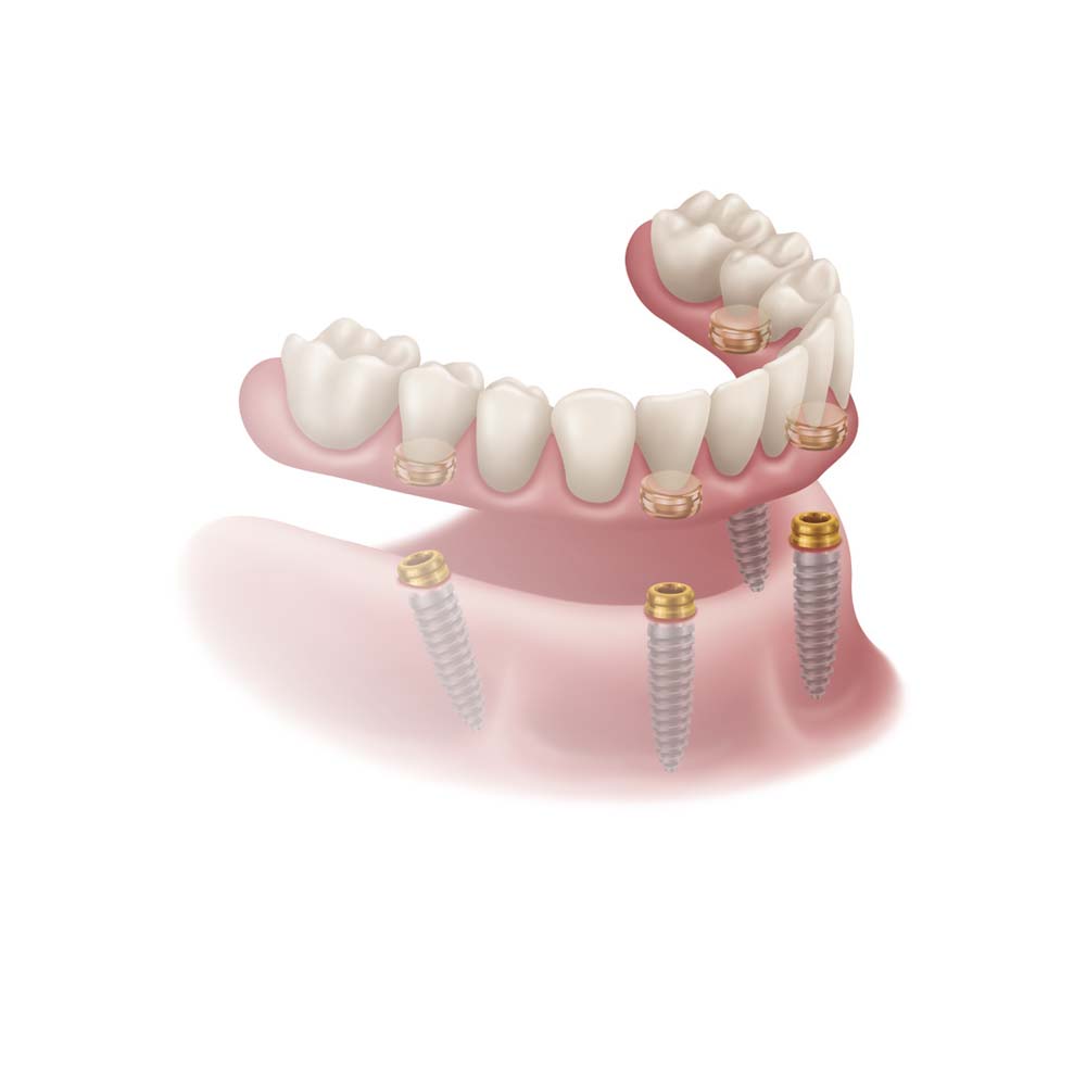 Xcem Denture Locator Abutment - Hex
