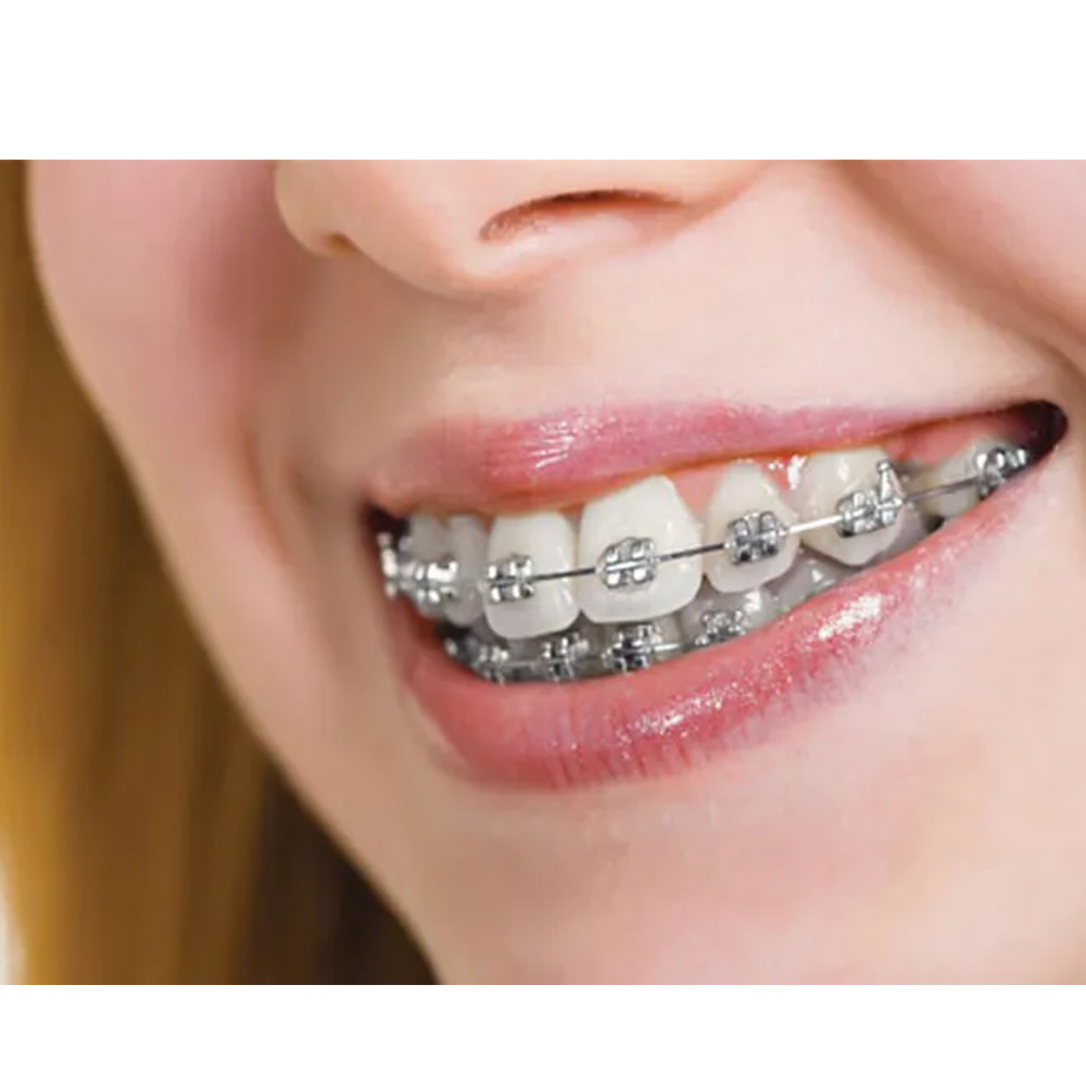 Koden Reverse Curve NiTi Archwires - Round (Pack of 2)